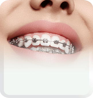 aligners and braces type