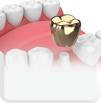 dental crowns type
