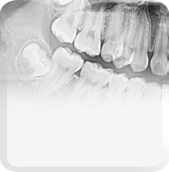 wisdom tooth extraction reason